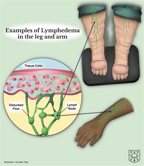 lymph fluid leaking from scalp|Lymphedema